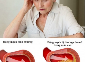 Mỡ trong máu cao uống thuốc gì? 04 nhóm thuốc điều trị mỡ máu cao hiệu quả